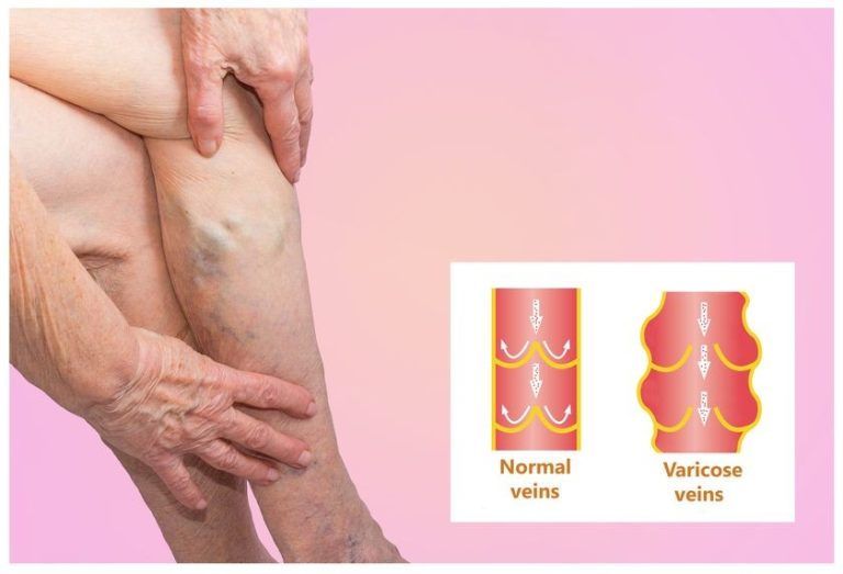 Everything You Need To Know About Varicose Veins